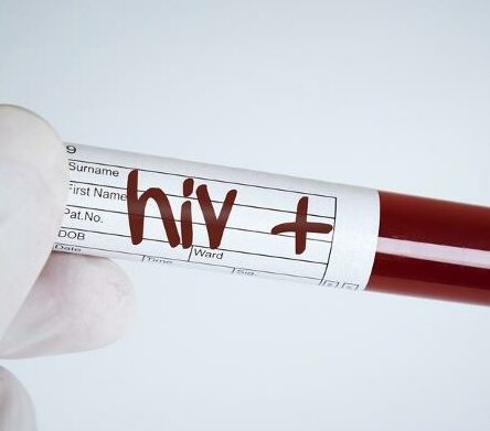 13 casi di Aids nel 2023, è allarme